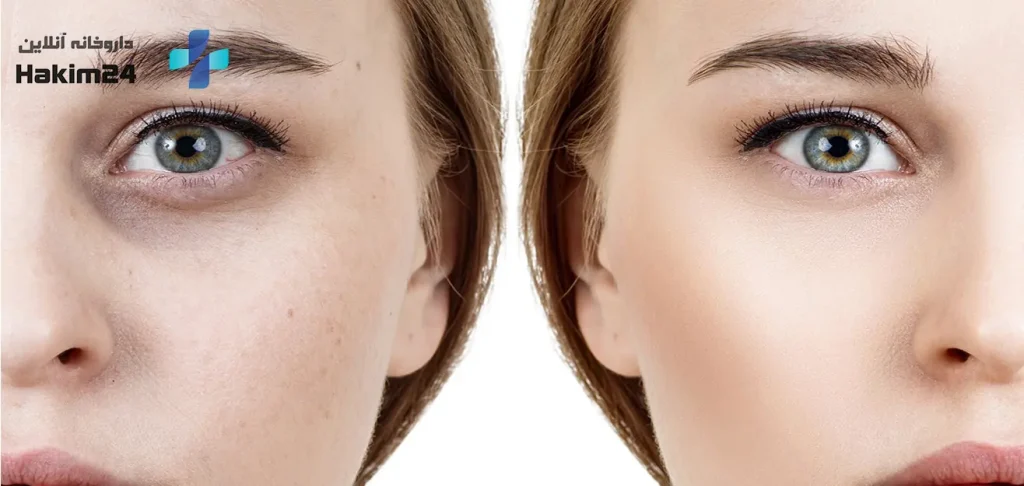 تیرگی زیر چشم چرا ایجاد می شود؟