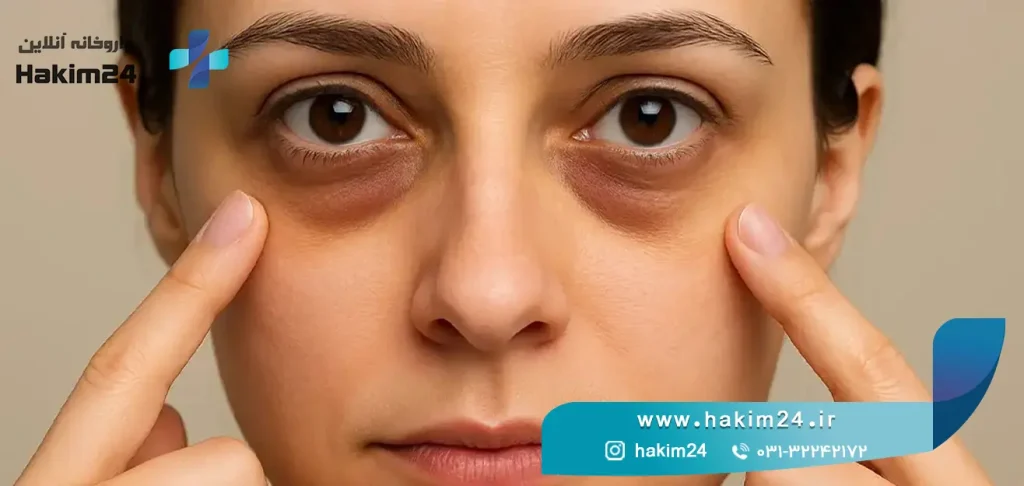 موثرترین روش های رفع تیرگی زیر چشم + معرفی محصولات موثر