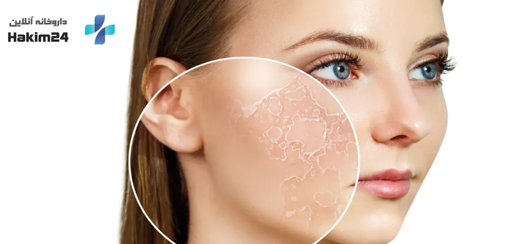 چگونه علائم خشکی پوست را تشخیص دهیم؟