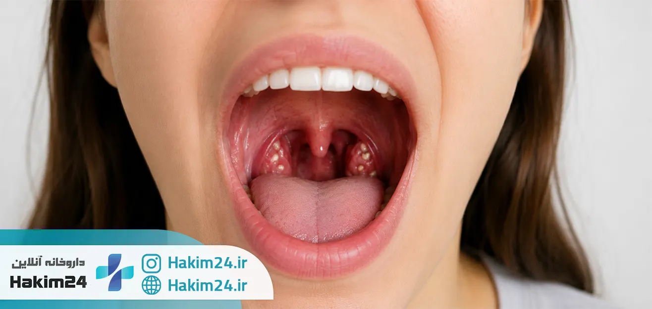  سنگ لوزه چیست ؟