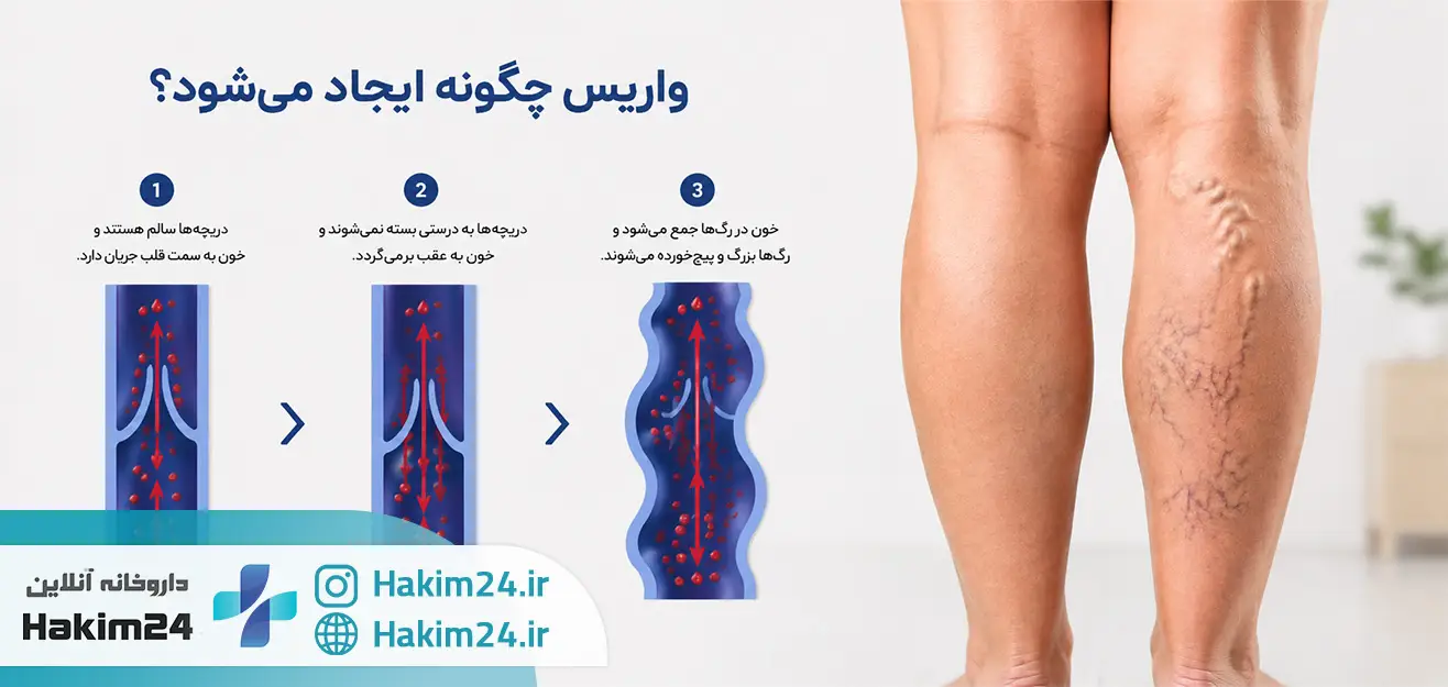 مراحل ایجاد واریس و تجمع خون در رگ‌های پا