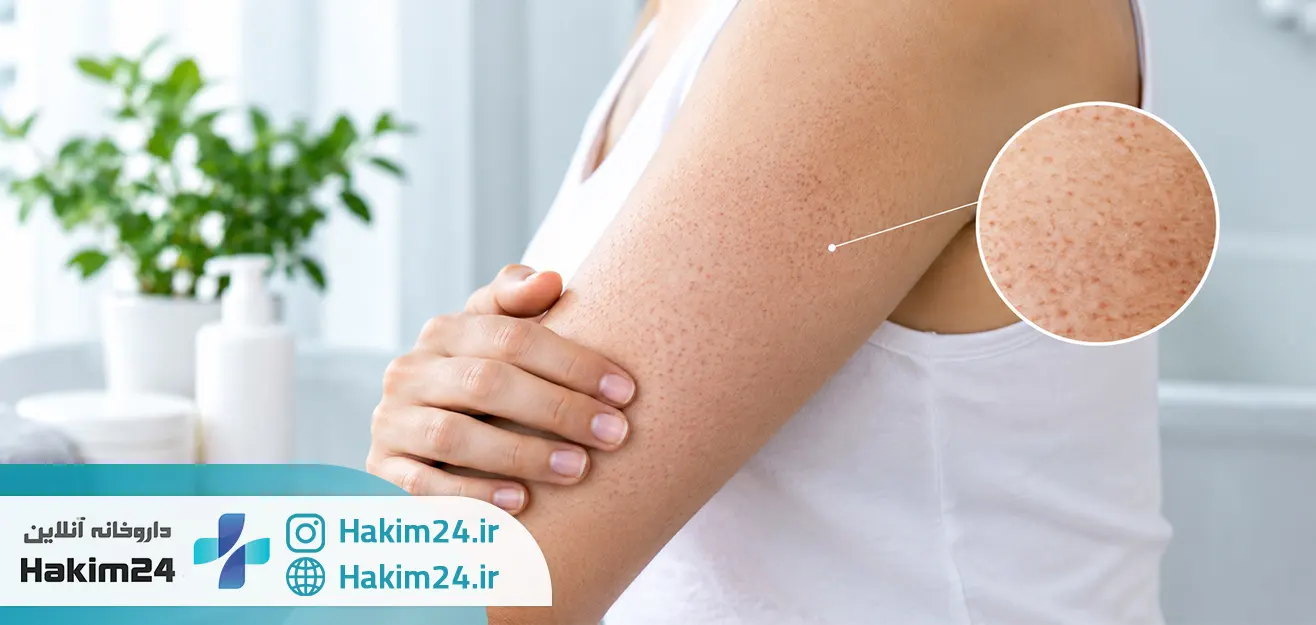 پوست مرغی چیست و چرا روی پوست ایجاد می شود؟