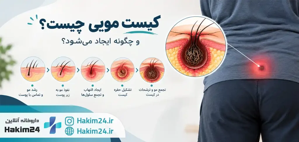«مراحل ایجاد کیست مویی از ورود مو به زیر پوست تا تشکیل کیست»