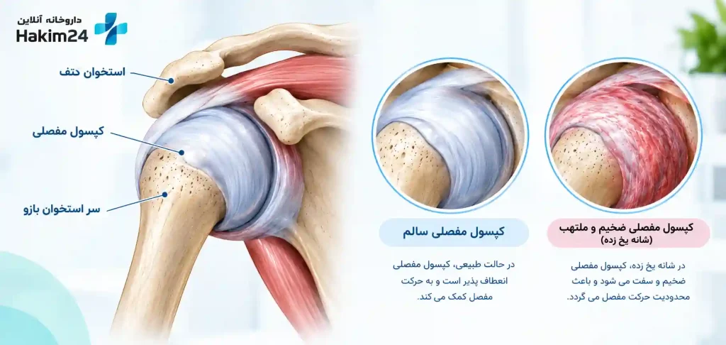 ساختار مفصل شانه و کپسول مفصلی در شانه یخ زده، همراه با مقایسه کپسول مفصلی سالم و کپسول ضخیم و ملتهب.