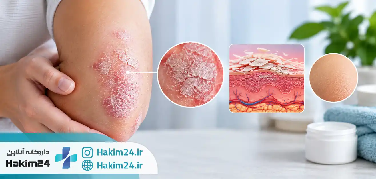 پسوریازیس چیست؟ علائم اولیه، عوامل تشدید کننده و راه های درمان