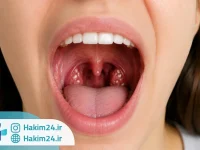 نمایی از دهان باز با مشاهده لوزه ها و دانه های سفید کوچک در حفره های لوزه، مرتبط با سنگ لوزه.