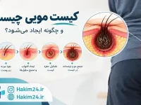 «مراحل ایجاد کیست مویی از ورود مو به زیر پوست تا تشکیل کیست»