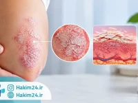 تصویر علائم پسوریازیس روی پوست، پوسته ریزی و مقایسه با بافت سالم پوست