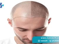 محافظت از موهای کاشته شده