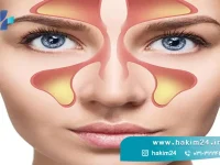 بیماری سینوزیت